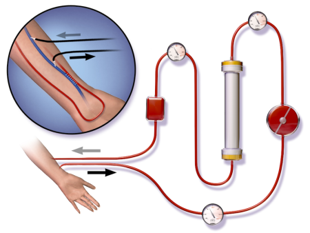 Schema einer Dialyse mit Dialysefilter.